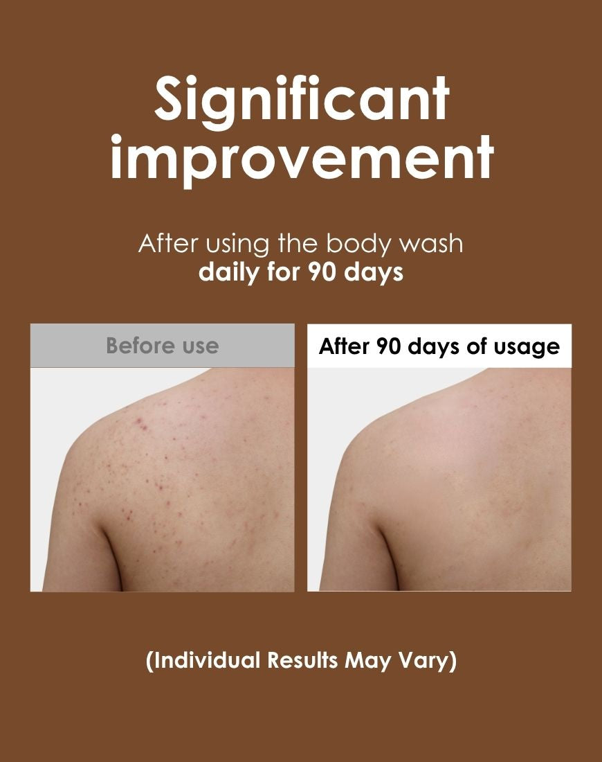 Apestomen Exfoliating & Anti-Acne Body Wash 350ml With Salicylic Acid | Treat Back Acne & Improve Overall Skin Appearance